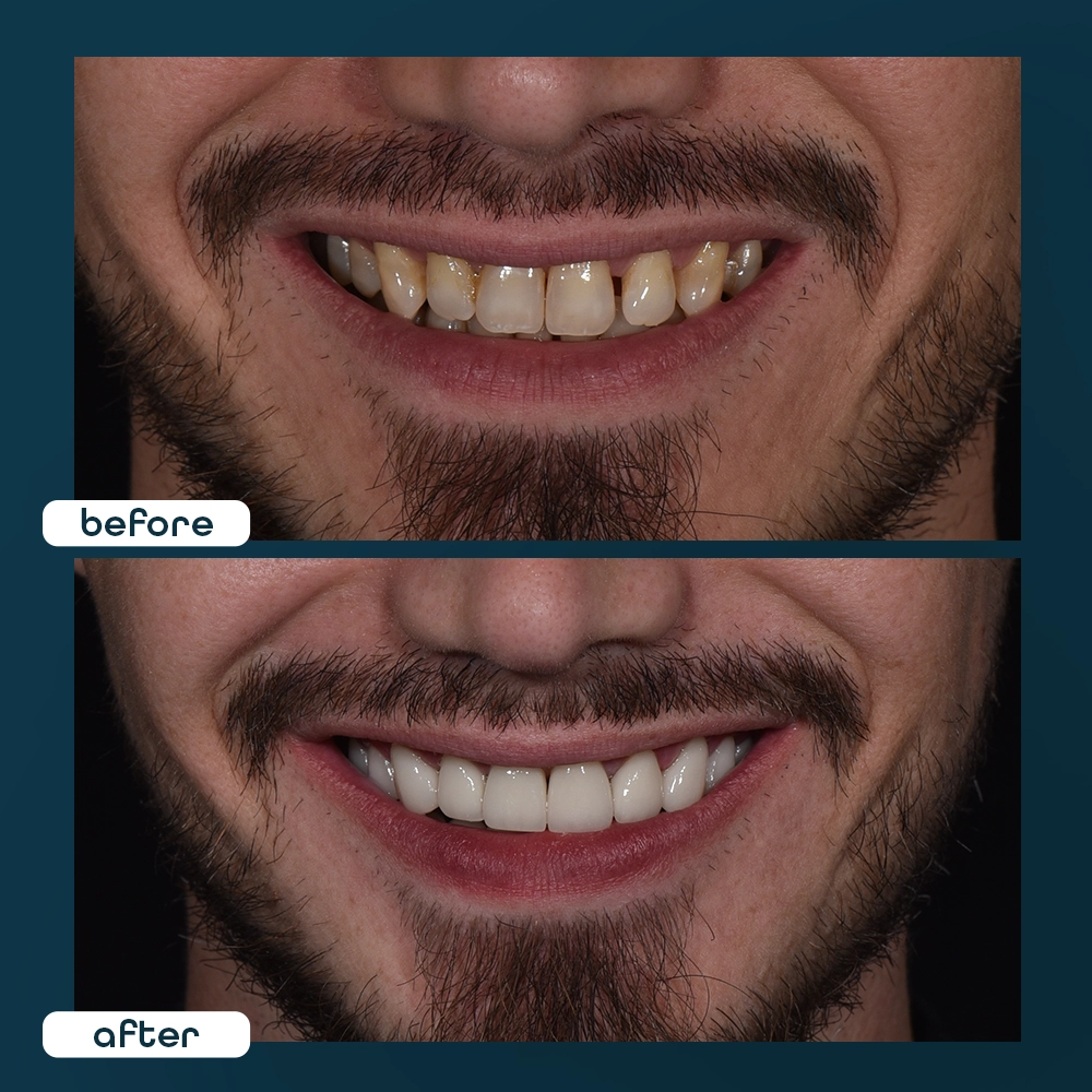 o╠êzgu╠êr before after2