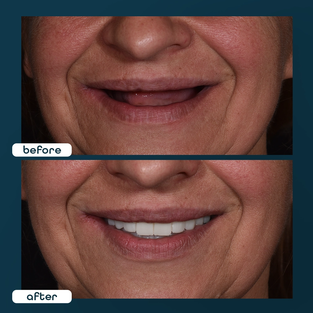o╠êzgu╠êr before after3