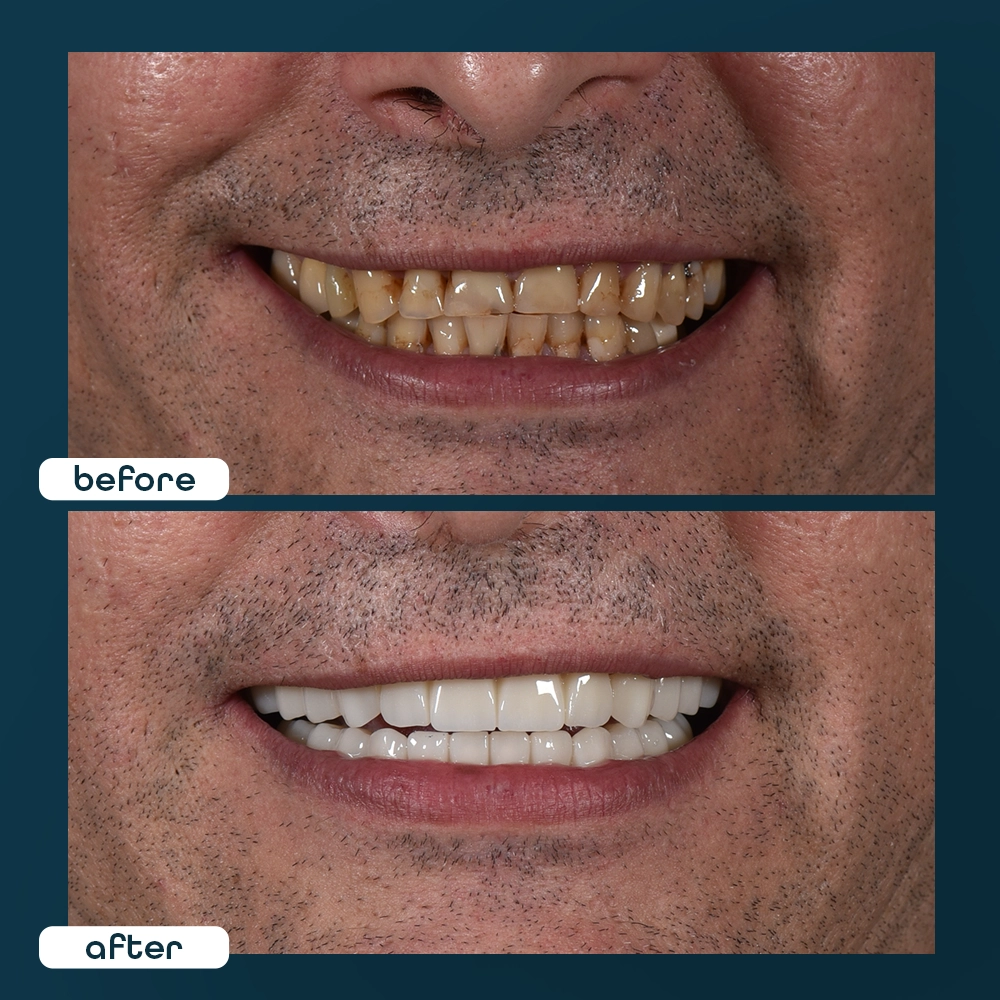 o╠êzgu╠êr before after4